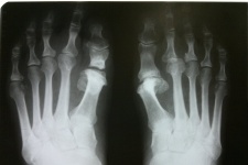 Hallux valgus