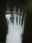 Hallux valgus