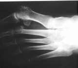 Hallux valgus