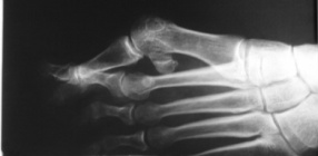 Hallux valgus