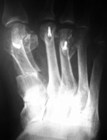 Hallux valgus