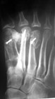 Hallux valgus