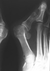 Hallux valgus