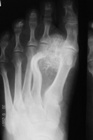 Hallux valgus