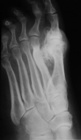 Hallux valgus