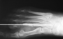 Hallux valgus
