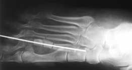 Hallux valgus